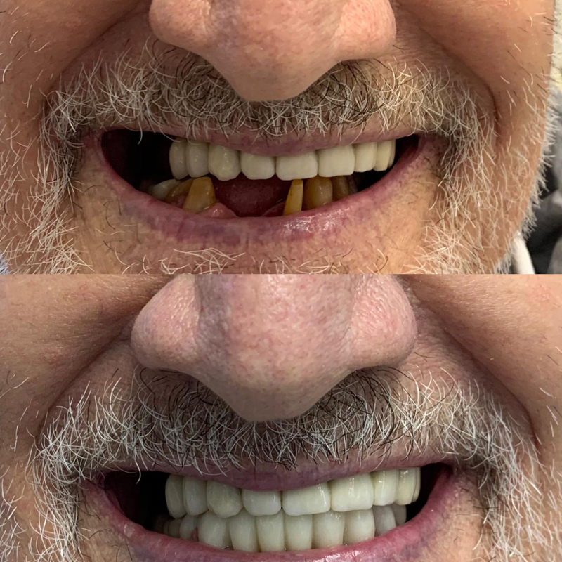 Dental Implants