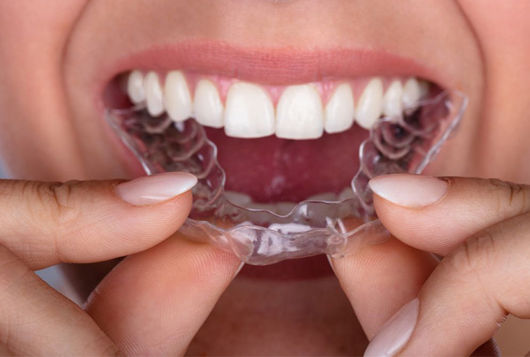 active-aligner-teeth-straignthening dentist in Parktown North