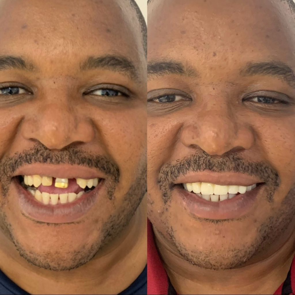 Removing Gold Slits