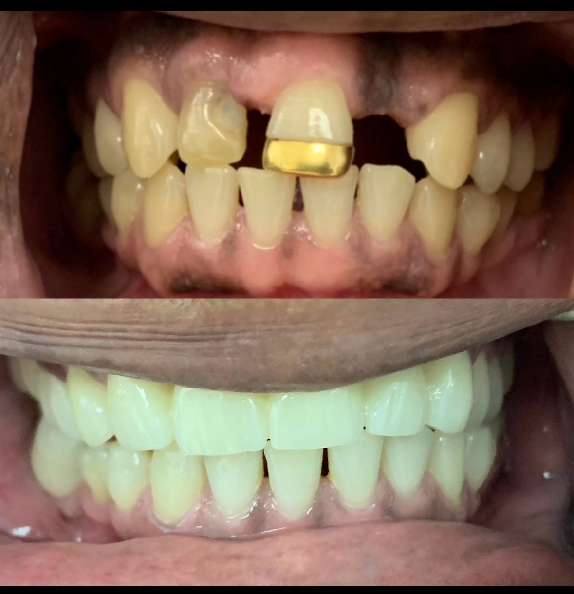 Removing Gold Slits
