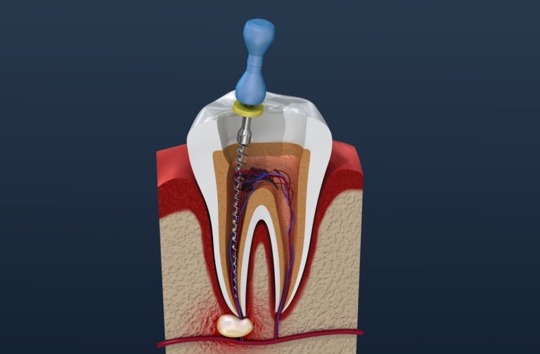 root canal