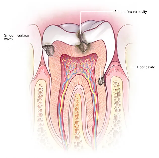 cavities